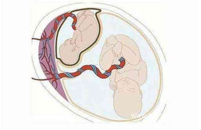 男婴腹中藏寄生胎 寄生胎究竟如何形成